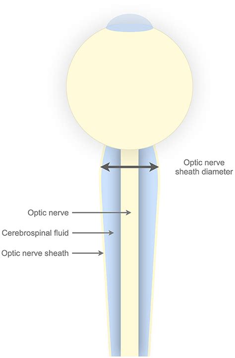 optic nerve thickness test|normal optic nerve sheath diameter.